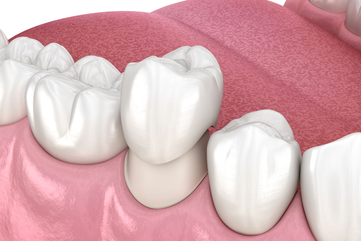 Corona dentale render 3d