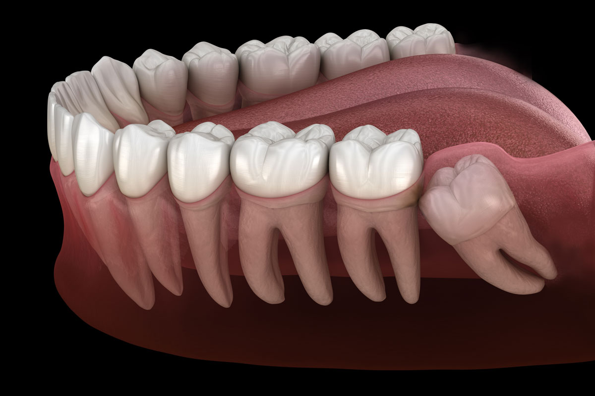 Render 3D dente del giudizio sotto la gengiva